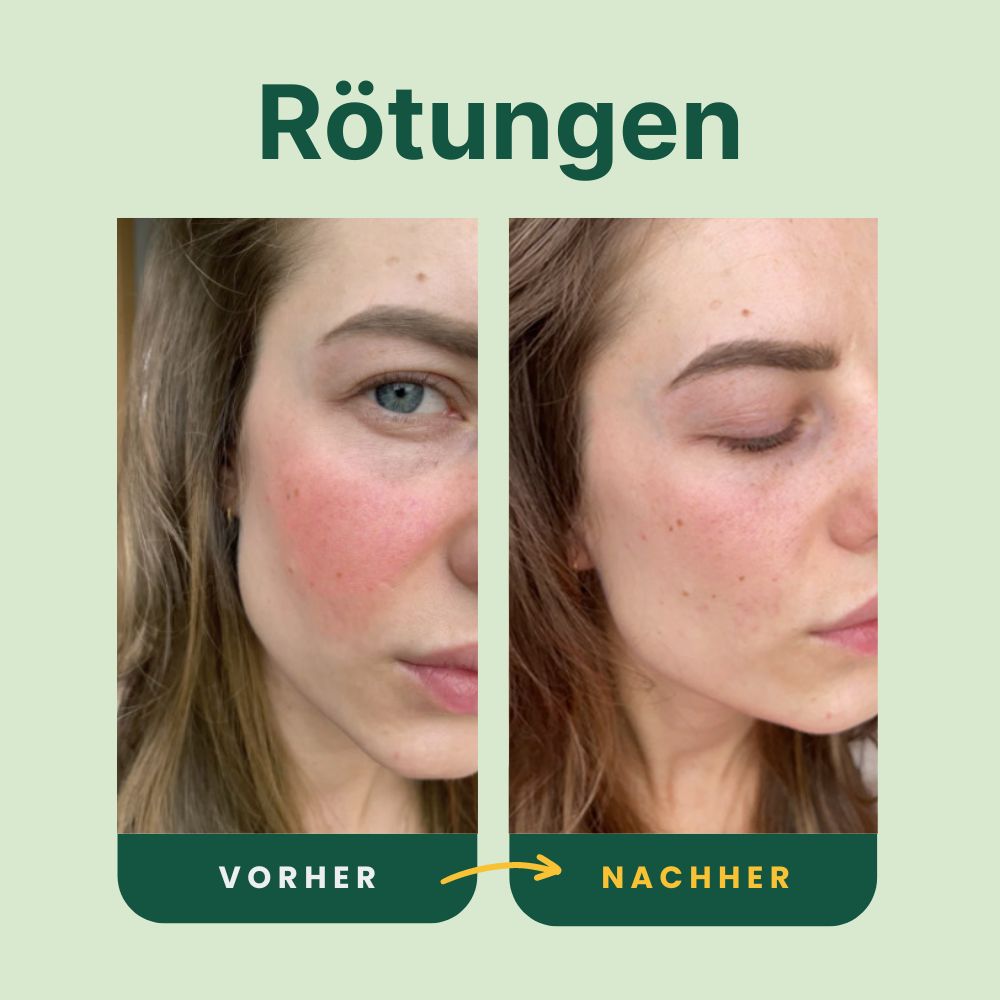 Koanna® MultiGlo™ LED Lichttherapie-Maske