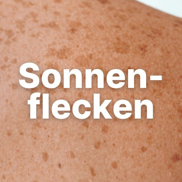 Pigmentflecken